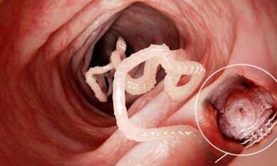 How to know the presence of parasites in the human intestines